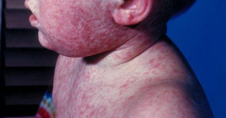 Kentucky Faces Largest Measles Outbreak In 16 Years With Nearly 200 Cases