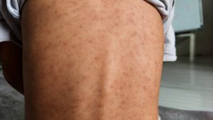 Kentucky Measles Cases Top 100 As Health Officials Urge Vaccination Checks