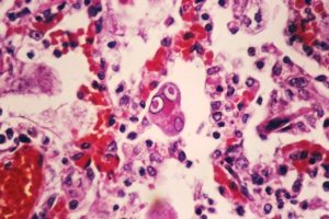 Measles Case Confirmed In Kosciusko County As Indiana Outbreak Reaches 73 Infect