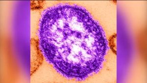 Oxford Area High School Closes Friday After Measles Case Identified