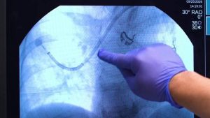 San Antonio Lung Cancer Survivor Urges Nonsmokers To Consider Screening
