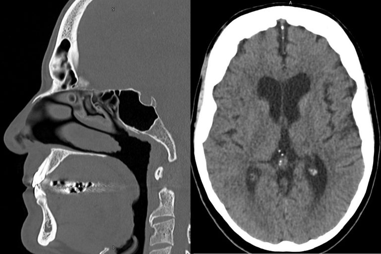 San Antonio Researchers Launch Ai Study To Detect Mild Brain Injuries In Veteran