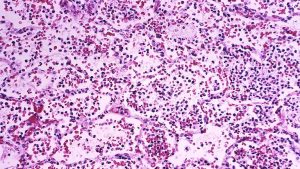 U S Monitors Suspected Pneumonic Plague Case In Siberian Lab Health Officials Ex