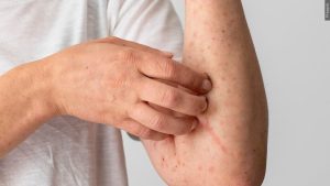 Wright County Health Department Alerts Residents To Three Confirmed Measles Case